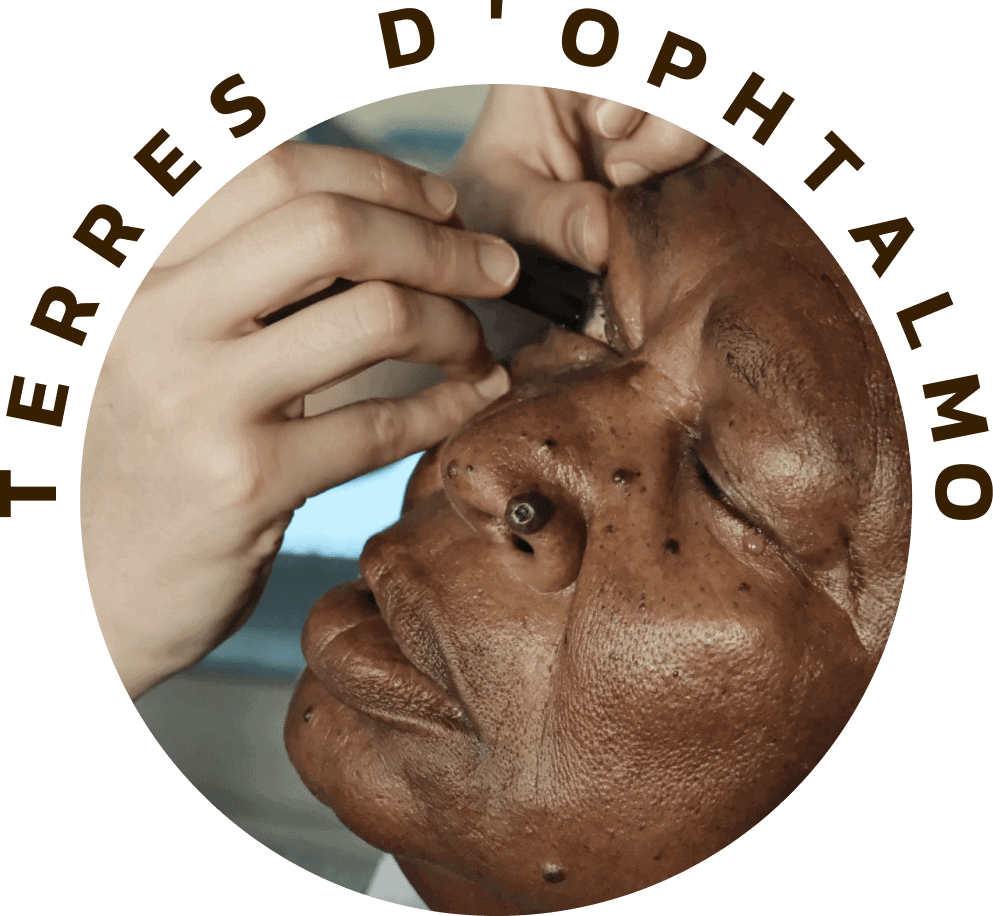 lutter contre la cécité terres d ophtalmo association d ophtalmologistes